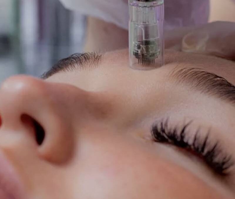 Microneedling Viso