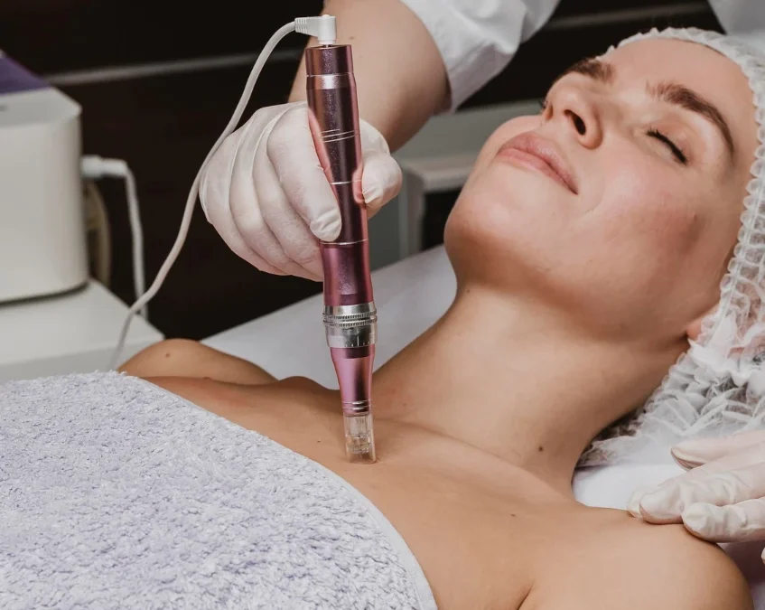 Microneedling Corpo